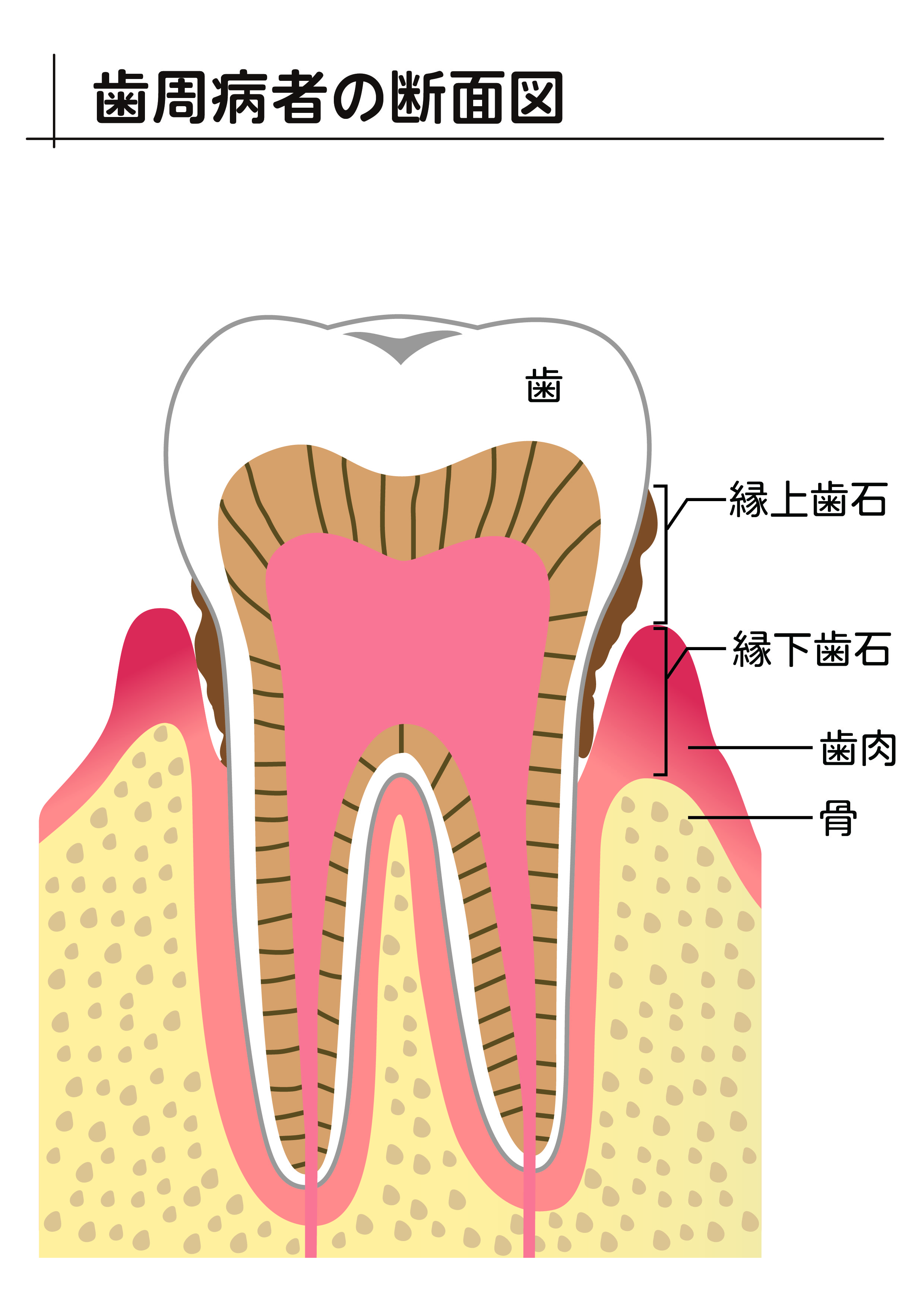 歯周病の断面