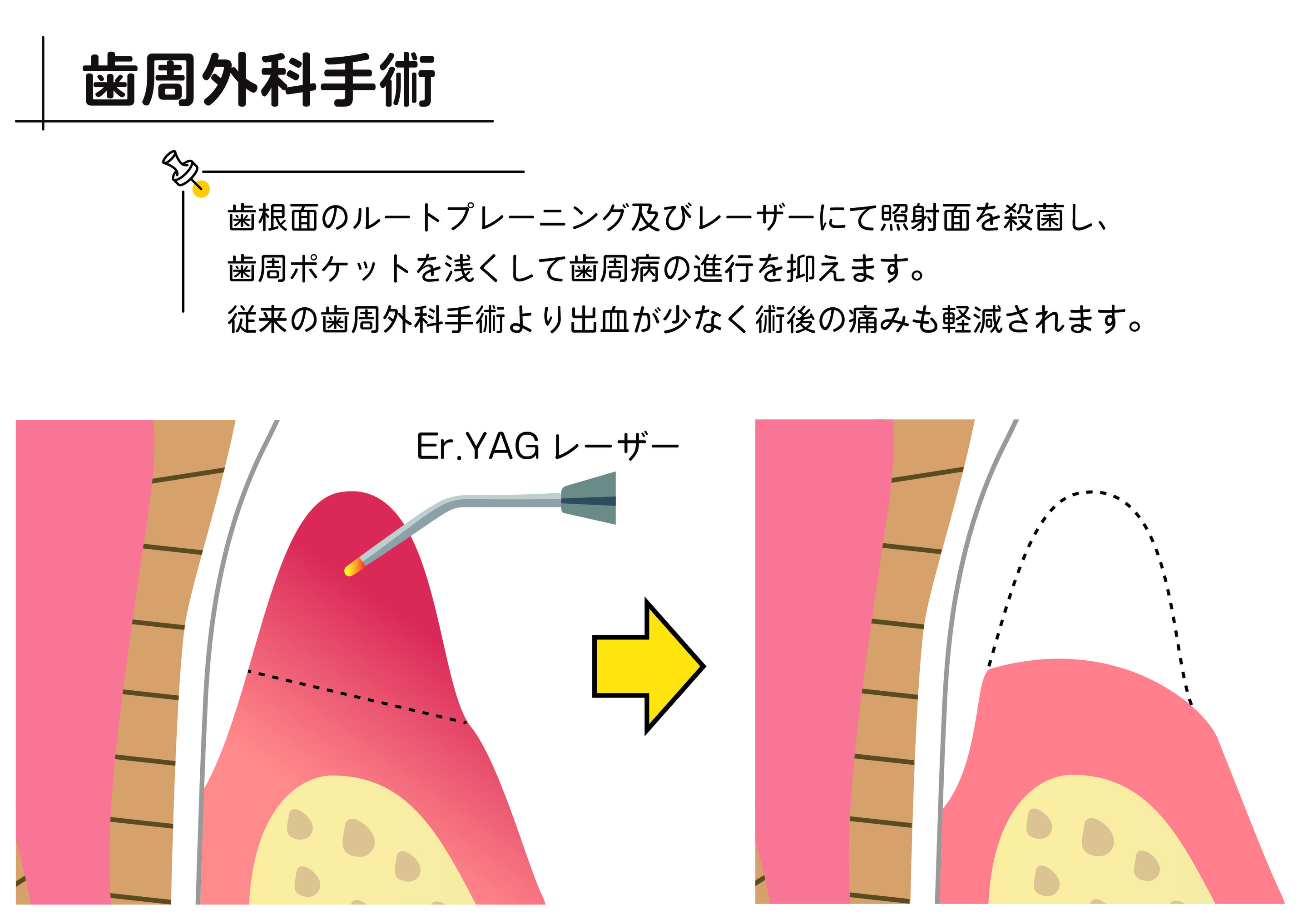 歯周外科手術