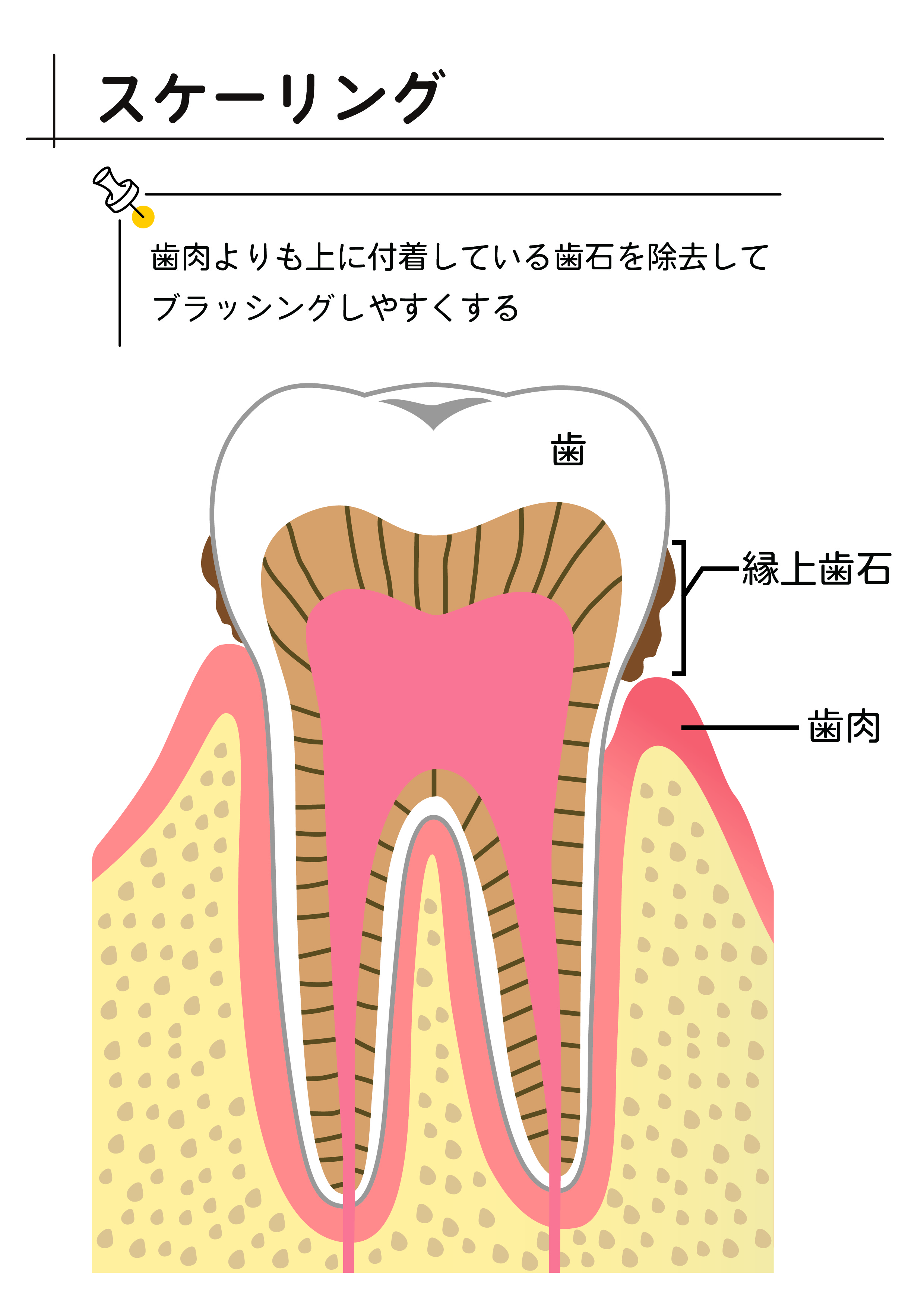 スケーリング