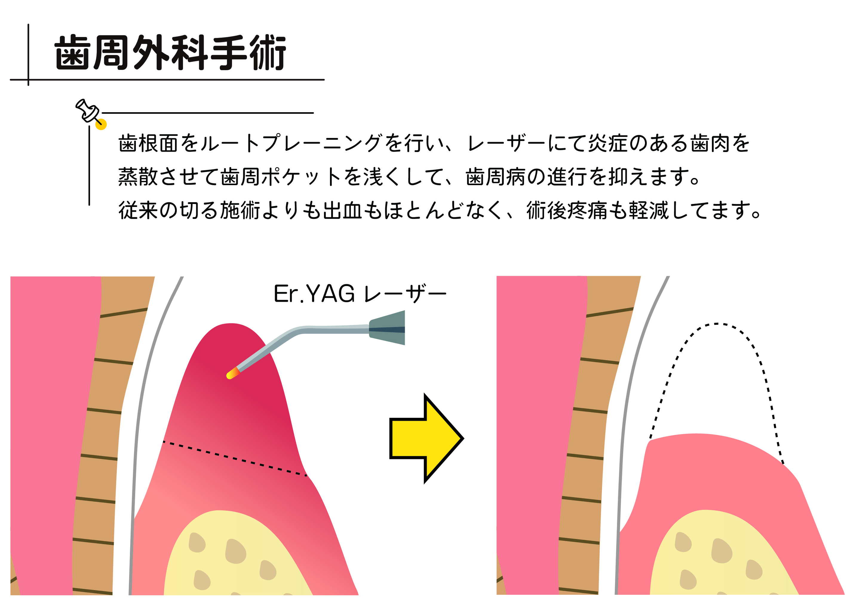 歯周外科手術